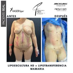 Lipoescultura - Clínica de la Figura