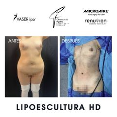Lipoescultura - Clínica de la Figura