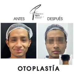Otoplastia - Clínica de la Figura