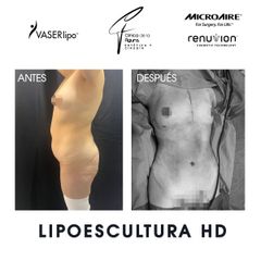 Lipoescultura - Clínica de la Figura