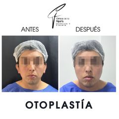 Otoplastia - Clínica de la Figura