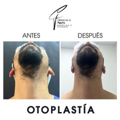 Otoplastia - Clínica de la Figura