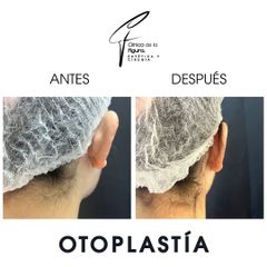 Otoplastia - Clínica de la Figura