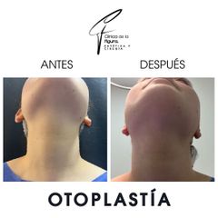 Otoplastia - Clínica de la Figura
