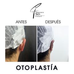 Otoplastia - Clínica de la Figura