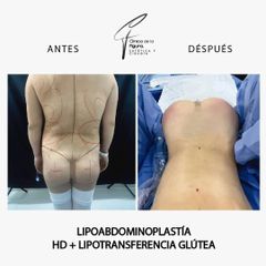 Lipoabdominoplastia - Clínica de la Figura