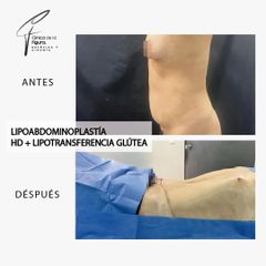 Lipoabdominoplastia - Clínica de la Figura