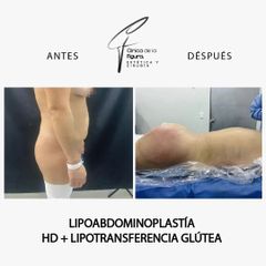 Lipoabdominoplastia - Clínica de la Figura