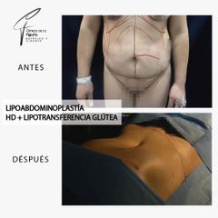 Lipoabdominoplastia- Clínica de la Figura