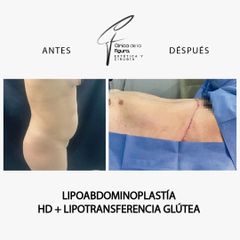 Lipoabdominoplastia - Clínica de la Figura