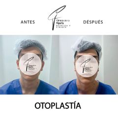 Otoplastia - Clínica de la Figura