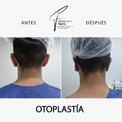 Otoplastia - Clínica de la Figura