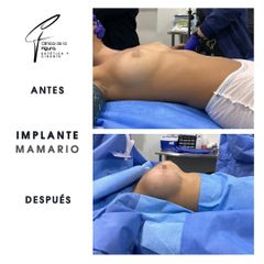 Aumento mamario - Clínica de la Figura
