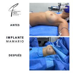 Aumento mamario - Clínica de la Figura