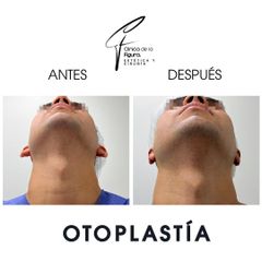Otoplastia - Clínica de la Figura
