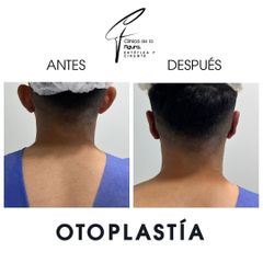 Otoplastia - Clínica de la Figura