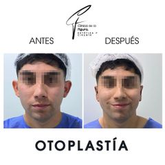 Otoplastia - Clínica de la Figura