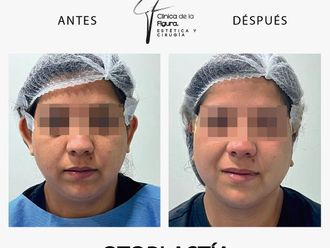 Otoplastia antes y después - 865940