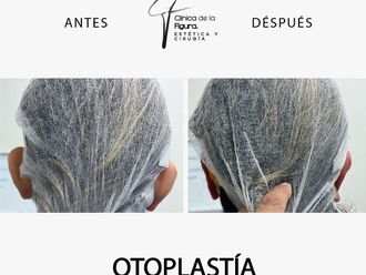 Otoplastia antes y después - 865941