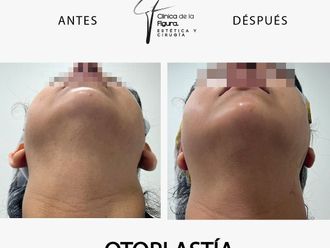 Otoplastia antes y después - 865942