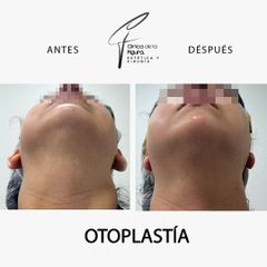 Otopastia - Clínica de la Figura