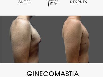 Ginecomastia antes y después - 870712