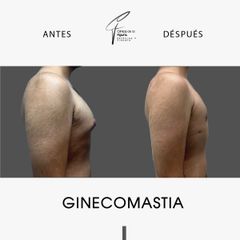 Ginecomastia - Clínica de la Figura