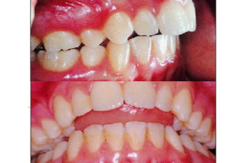 Brackets antes y después - 501506