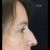 Rinoplastia, feliz con mi rinoplastia