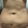 Me decidí y me hice una lipoláser abdominal