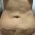 Me decidí y me hice una lipoláser abdominal