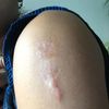 Queloide en hombro izquierdo