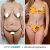 El sábado 26/09 me hicieron una abdominoplastia con lipoaspiración Váser Circunferencial 
