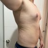 Ginecomastia y Lipo sin Problemas