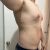 Ginecomastia y Lipo sin Problemas