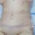 Abdominoplastia, me operé el 19 de julio con el dr Arturo Aguirre en la clínica Huinganal.