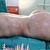 Lipováser en tronco completo + injerto en glúteos
