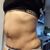 Me realice una lipo abdominal con  abdominoplastia