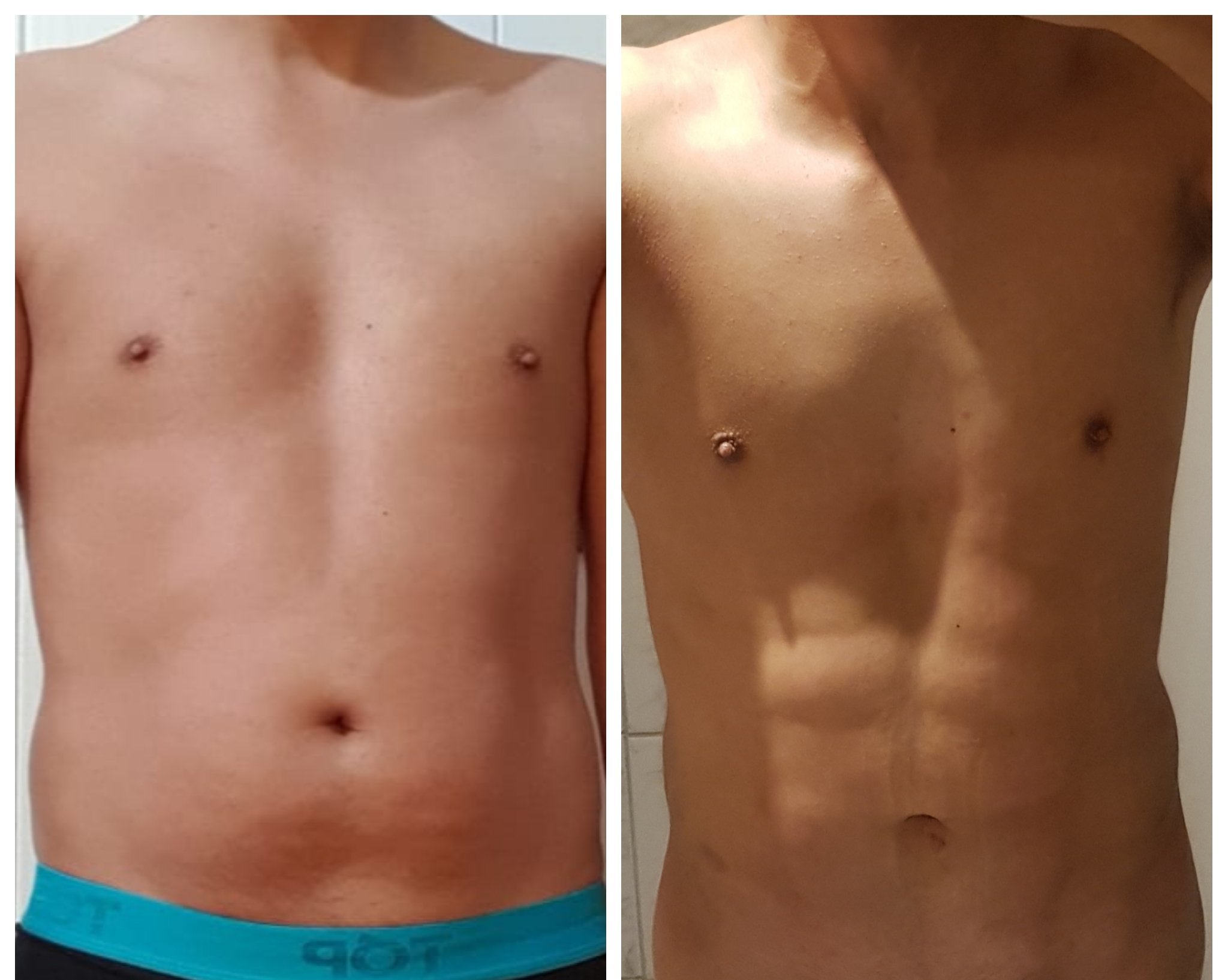 Lipovaser Hombres Recomendado Liposuccion Clinicasesteticas Cl