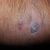 Joven fustrado tras tratamiento del acne y manchas de la piel