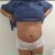 Lipoescultura para una novia!! Después de la tormenta sale el sol 