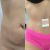 Abdominoplastia + Lipo en Leben & Körper
