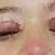 A mis 34 me atreví a una blefaroplastia!!!