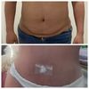 Lipoabdominoplastía Dr. Jose Vielma Mora