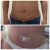 Lipoabdominoplastía Dr. Jose Vielma Mora