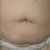Mi post operatorio de la abdominoplastia