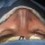Mi experiencia con rinoplastia secundaria junto al Dr. Gustavo: un cirujano excepcional