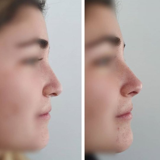 Acido hialuronico en la nariz - Ácido hialurónico - Clinicasesteticas.cl