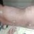 4 meses de mi abdominoplastia