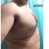 Un cambio de vida con Ginecomastia y liposucción